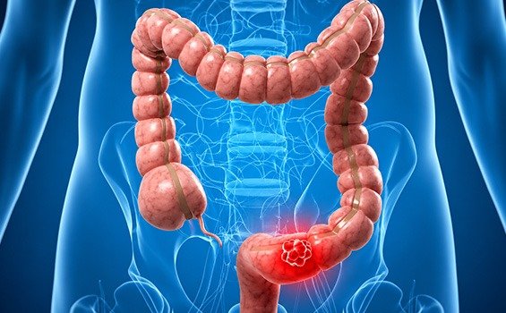 What Types of GI Cancers Can Be Treated with Minimally Invasive Surgery?