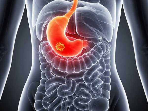 How to Prepare for Neuroendocrine Tumour Surgery?