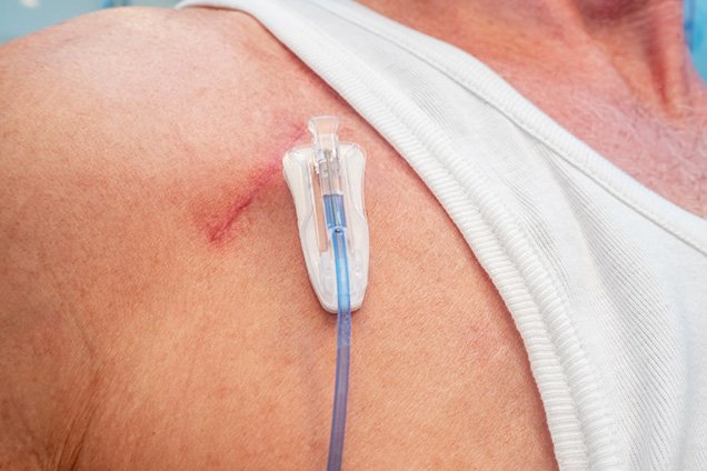 Chemo Port
