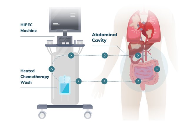 HIPEC Procedure
