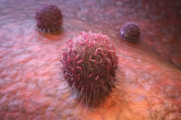 HIPEC Cancer Treatment