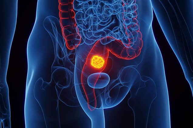 Types of Sphincter Preserving Procedures