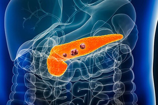 Risks & Complications of Whipple Surgery