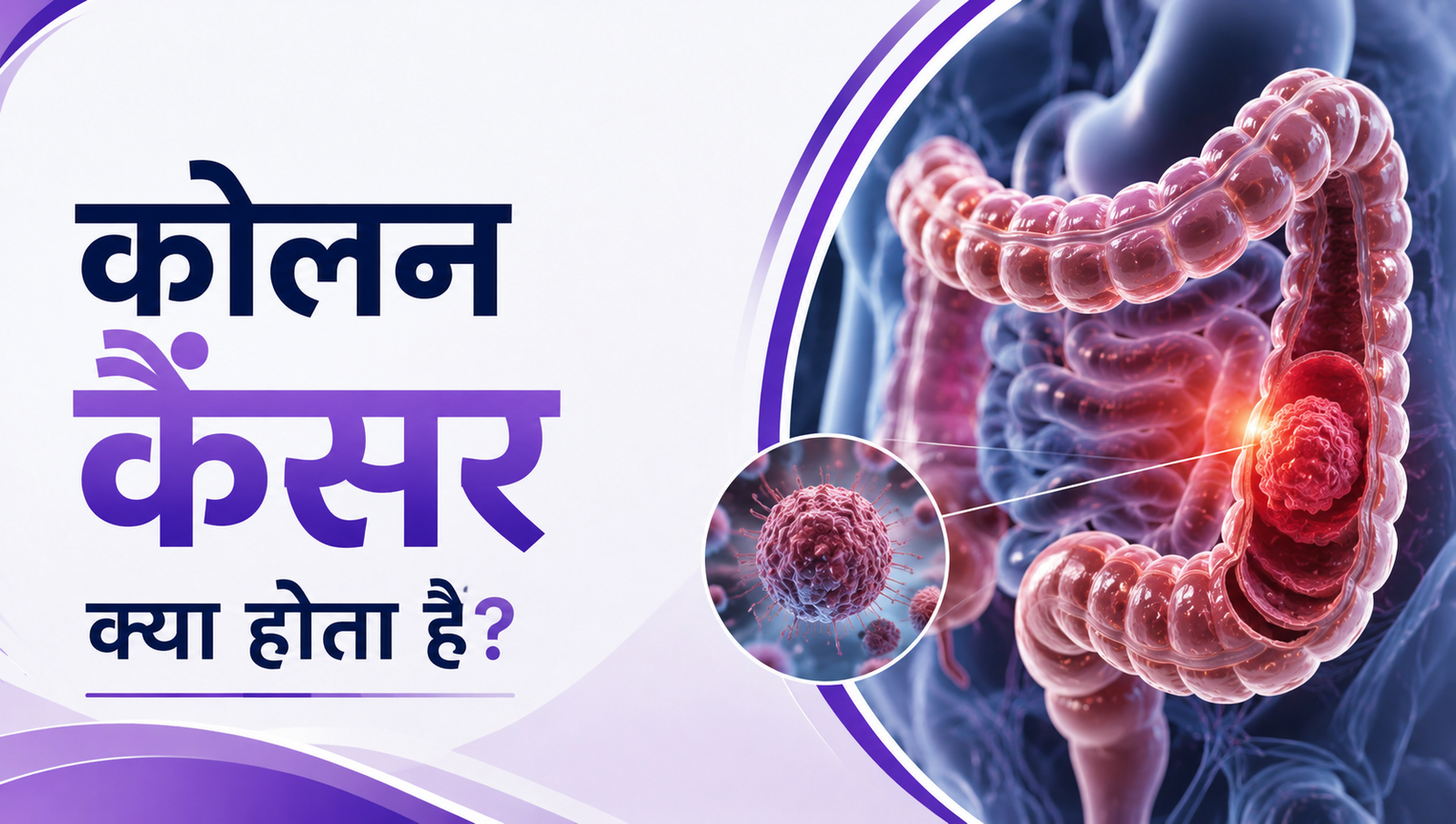 कोलन कैंसर क्या होता है